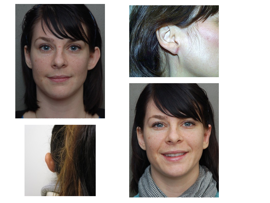 OTOPLASTY